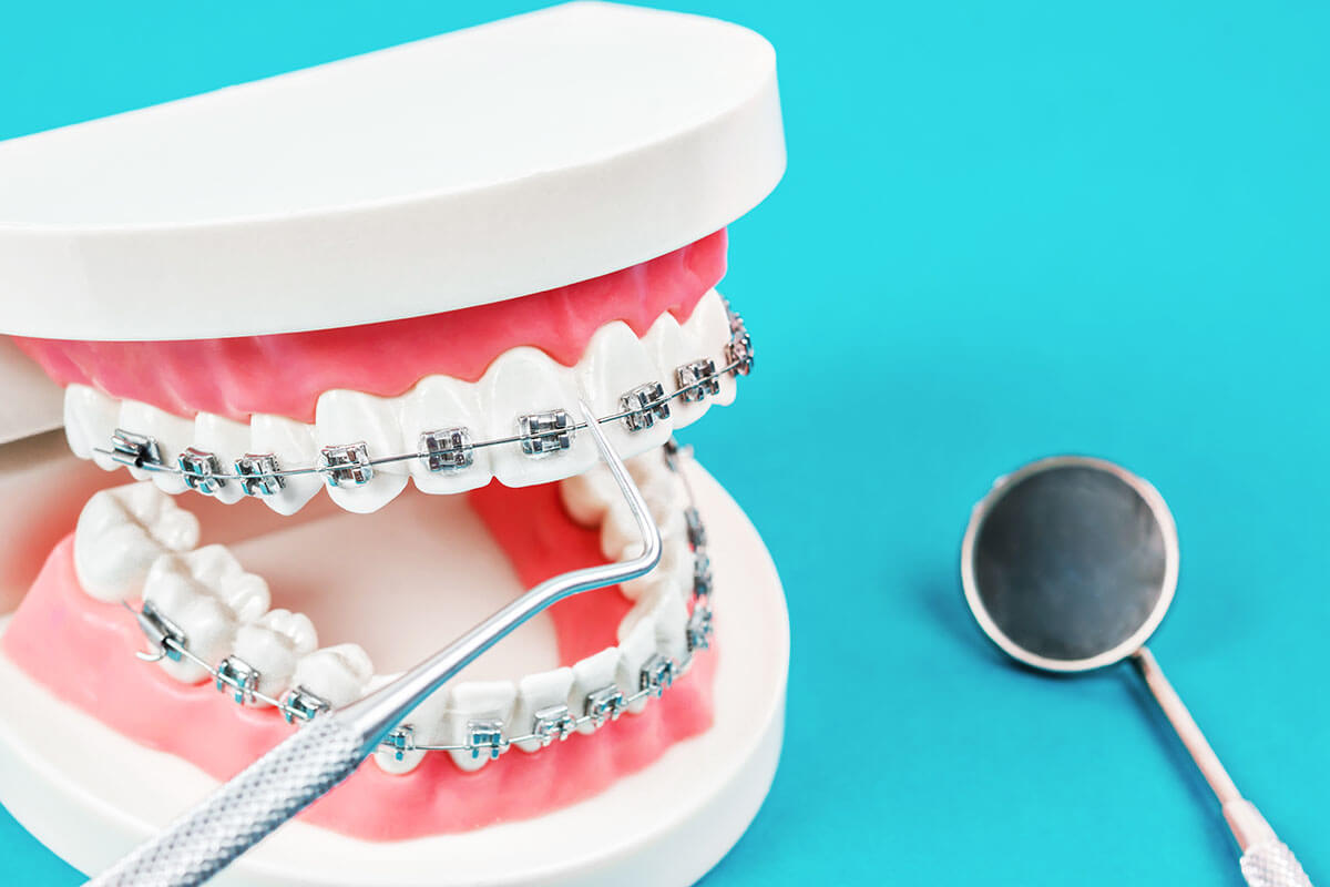 What are Dental Braces?, Orthodontics