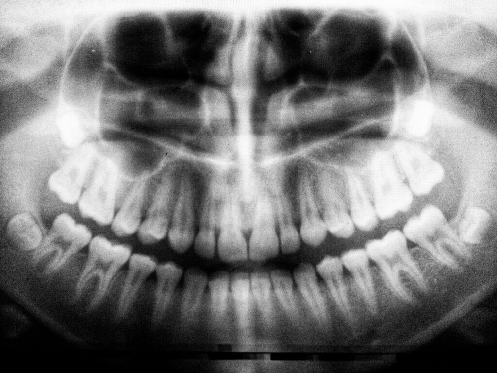 xray in preparation for oral surgery